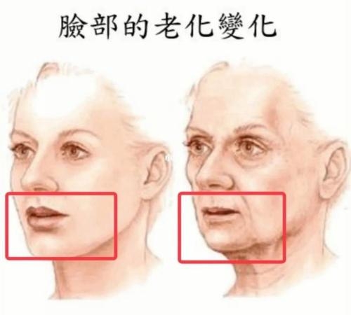 米扬丽格马平山医生采用PLLA艾维岚在口周年轻化方面的成果(图7)