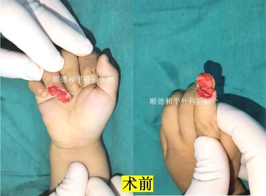 和平医院成功为2岁男童实现“手指再生”