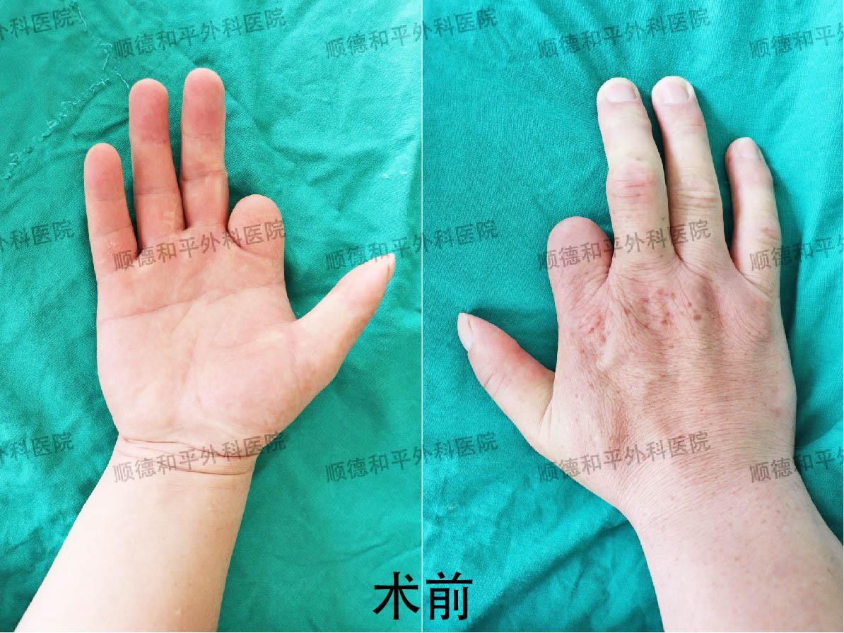 新疆患者失去手指心生自卑，远赴广东手指再造＿手外科医院咨询