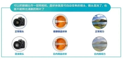 爱尔眼科：白内障不会“缺席”只会“迟到”？(图1)