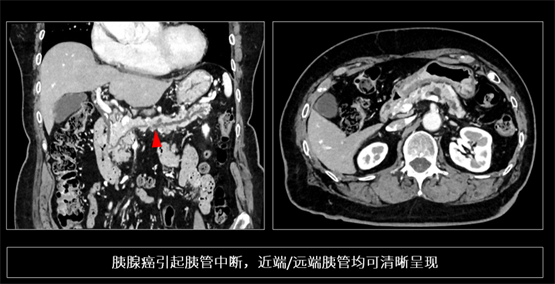 登陆中国,首款16cm光谱成像、超高清宽体CT国产上市(图5) 登陆中国,首款16cm光谱成像、超高清宽体CT国产上市(图5)