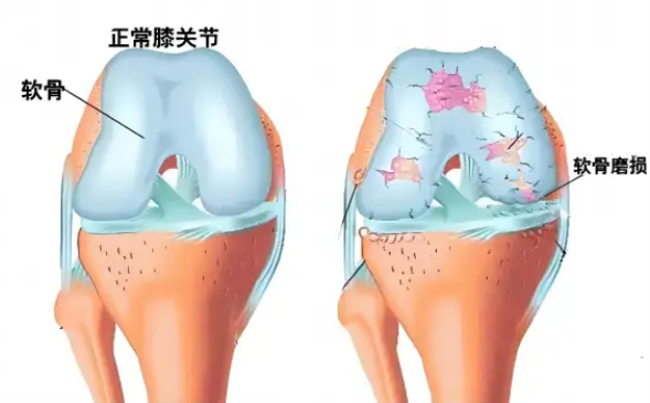 全网10大品牌氨糖软骨素实测盘点：关节养护选对款，高含量才是硬实力！(图4)